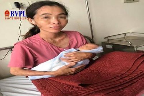Cứu sống thai nhi dây rốn thắt nút hiếm gặp