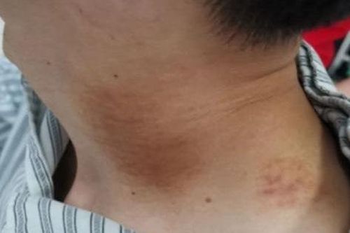 Bị đột quỵ cấp tính sau khi đi massage thư giãn, chuyên gia cảnh báo 6 dấu hiệu nguy hiểm