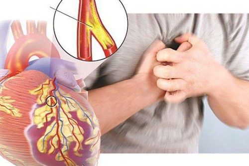 Nguy hiểm chết người từ những cơn đau thắt ngực