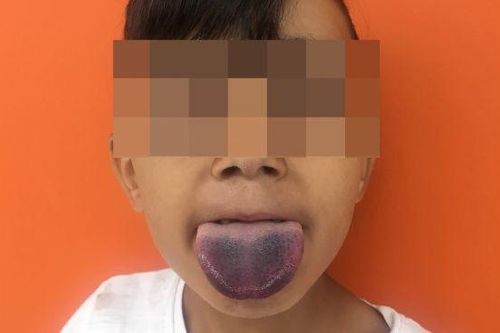 Cậu bé 7 tuổi phải nhập viện vì lưỡi mắc kẹt trong cổ chai