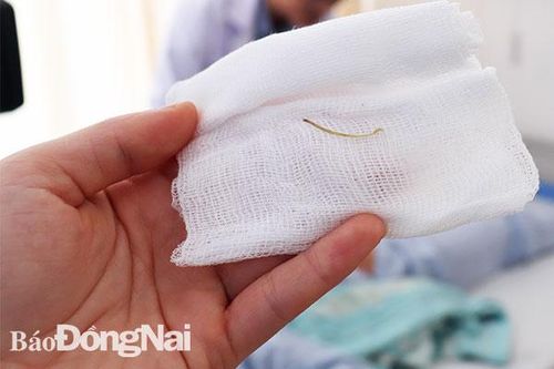 Chữa trị cho bệnh nhân bị xương cá đâm thủng ruột