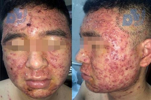 Mụn bọc chi chít khắp mặt do mua thuốc trên facebook về dùng