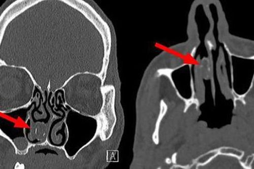 Cần sa bị mắc kẹt 18 năm trong lỗ mũi của cựu tù nhân
