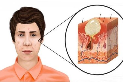 Nổi mụn chi chít vì mua thuốc trên mạng