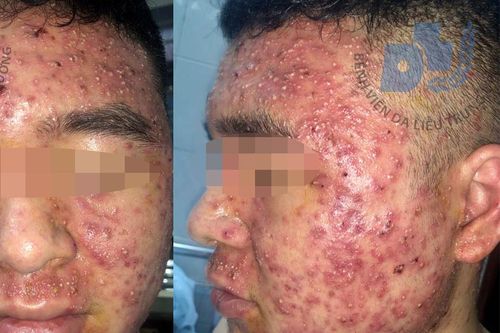 Dùng thuốc nam không nguồn gốc, nam thanh niên mụn bọc đầy mặt