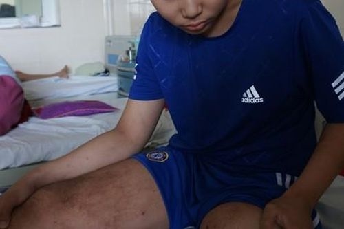 Ước mơ có 30 triệu để lắp chân giả của cậu bé bị ung thư xương