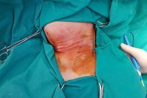 Hóc xương cá khiến nữ bệnh nhân thủng thực quản