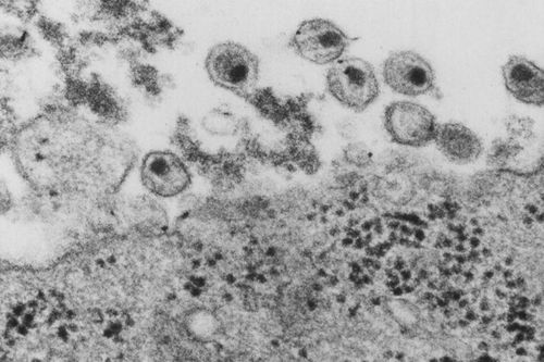 Phát hiện chủng virus HIV mới sau gần 20 năm