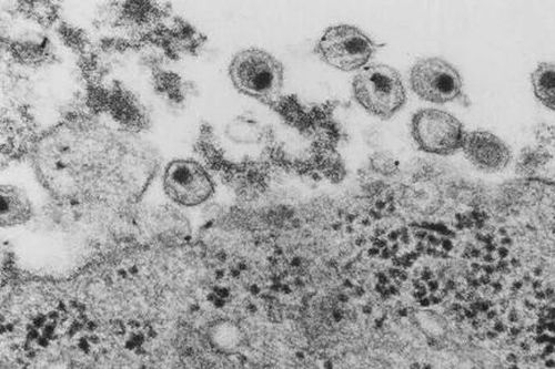 Phát hiện chủng HIV mới sau gần 20 năm
