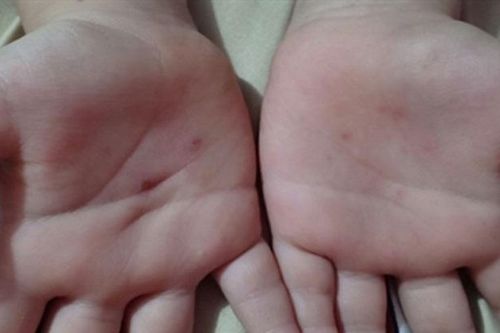 Điều tra thông tin cháu bé 5 tuổi bị giáo viên mầm non dùng vật nhọn đâm vào tay vì không nghe lời