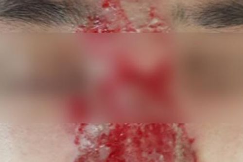 Mù mắt vì tiêm filler nâng mũi