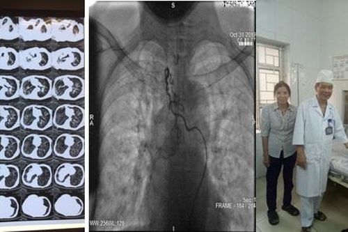 Cứu sống bệnh nhân 'ho ra máu sét đánh'