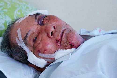 Cụ ông 80 tuổi kể lúc bị gã xe ôm đánh gãy xương