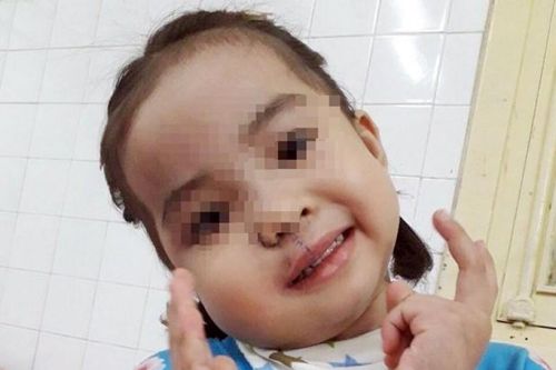 'Giải cứu' bé gái 4 tuổi khỏi u quái vùng mặt