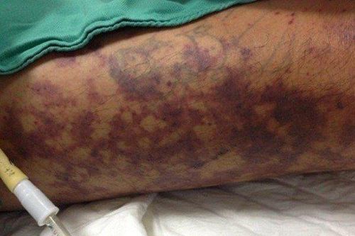 Tiểu thương thịt lợn suýt chết vì bị viêm màng não do liên cầu khuẩn