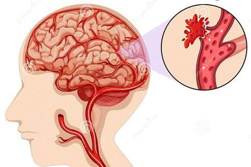 Chứng xuất huyết não nguy hiểm như thế nào?