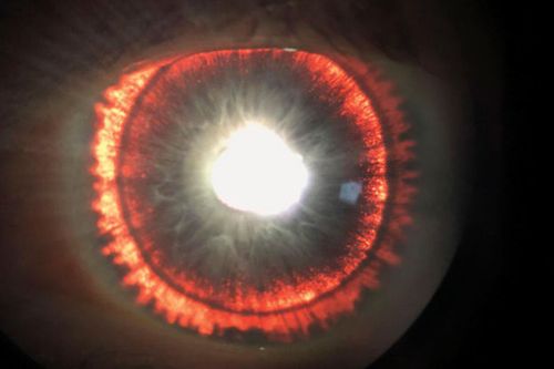 Bị bệnh hiếm gặp, người đàn ông có đôi mắt giống Sauron