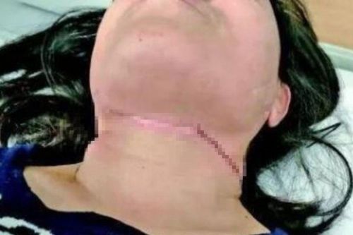 Người phụ nữ bị dây diều cứa cổ khi đang đi xe máy