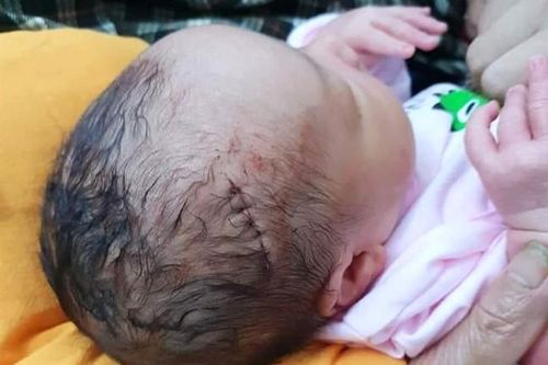 Bé sơ sinh phải khâu 6 mũi do bác sỹ sơ suất trong khi mổ