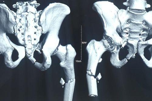 Cứu sống bệnh nhân bị đa chấn thương nặng có nguy cơ tử vong