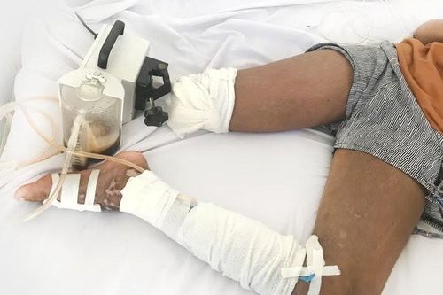 Bé gái 13 tuổi phải cắt bỏ chân vì nhờ thày lang vườn trị rắn cắn