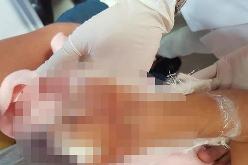 Cân não trước bàn tay phải gần đứt rời của bệnh nhi ba tuổi