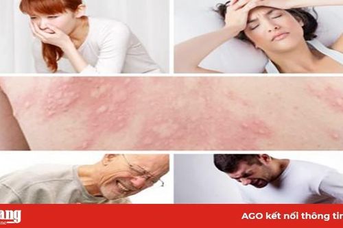 Sốc phản vệ - Xử lý sao cho đúng?