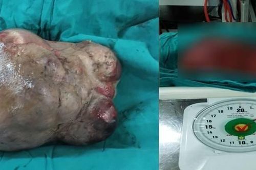 Giải thoát khối u nặng hơn 3 kg trên cổ người phụ nữ suốt 25 năm
