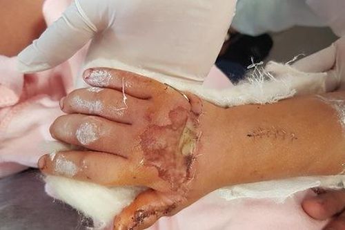 Cứu sống bé trai 6 tuổi vỡ gan do ngã cây