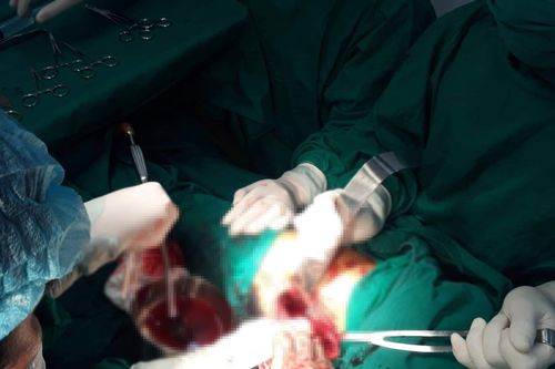 Quảng Nam: Cứu sống bệnh nhân Cơtu bị cây đâm thủng đùi