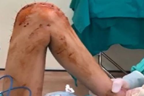 Đau đầu gối kéo dài, nữ sinh 16 tuổi bất ngờ phát hiện ung thư xương