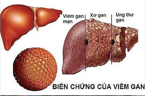 Tầm soát sớm ung thư tế bào gan