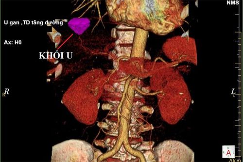 Thanh niên 28 tuổi mắc ung thư gan sau 10 năm nghiện rượu