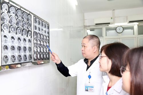 5 điều có thể bạn chưa biết về tai biến mạch máu não