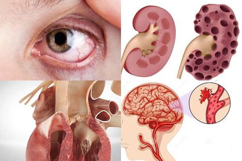 Căn bệnh giết người hàng đầu, 14 triệu người Việt Nam đang mắc