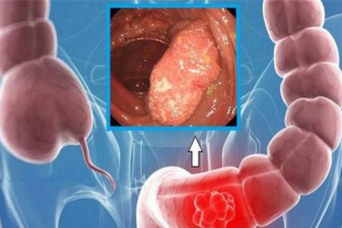 Cách đơn giản ngăn ngừa ung thư đại trực tràng ngay tại nhà