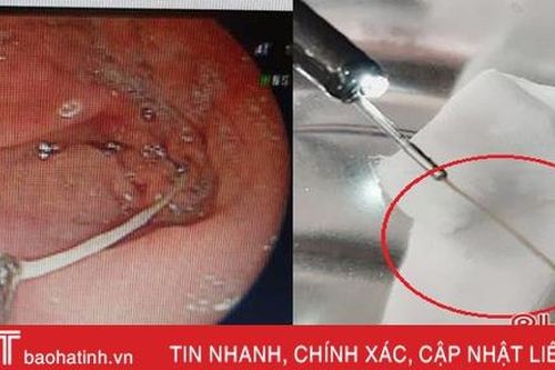 Nuốt tăm lúc ngủ quên, người đàn ông ở TP Hà Tĩnh suýt thủng dạ dày