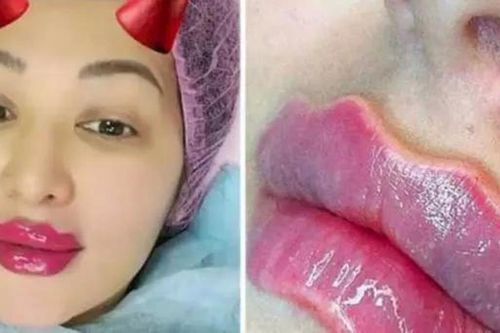 'Cặp môi của quỷ' – Trào lưu làm đẹp kỳ dị đang lây lan và lời cảnh báo đáng sợ