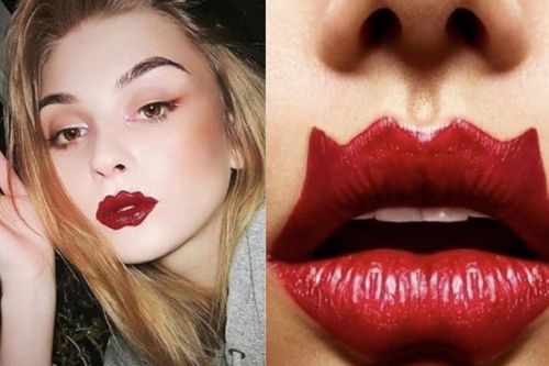 Môi bạch tuộc - trào lưu làm đẹp nhiều rủi ro