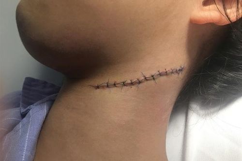 Vấp ngã, cô bé 14 tuổi bị mảnh bát cứa rách cổ