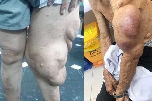 Cắt bỏ khối bướu sợi thần kinh khổng lồ khỏi cơ thể người đàn ông