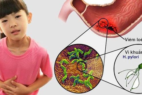 Viêm loét dạ dày tá tràng ở trẻ em tăng cao