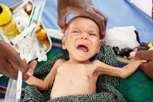 Khuyến nghị cải thiện suy dinh dưỡng ở trẻ em