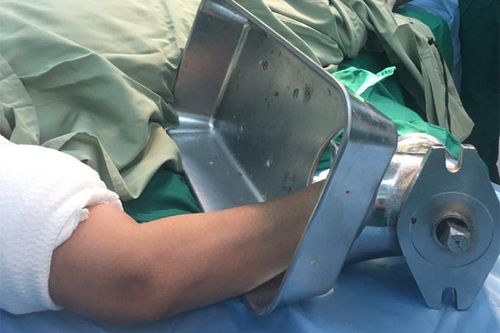 Bất cẩn trong lúc xay cá bị máy cuốn gần hết bàn tay