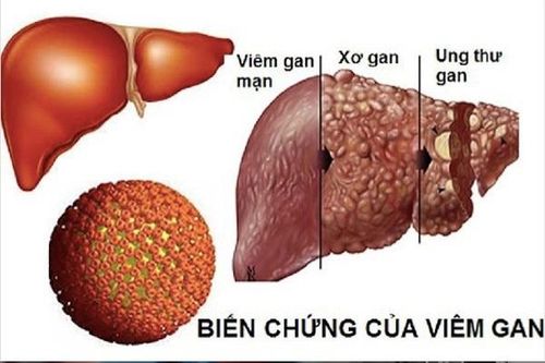 Giao lưu trực tuyến về nhận biết và xử trí sớm bệnh viêm gan B