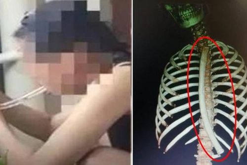 Cô gái kiên trì 'nuốt' ống nhựa và sự thực gây ám ảnh