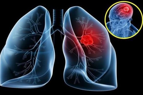 Mỗi năm hơn 20.000 người Việt tử vong vì ung thư phổi