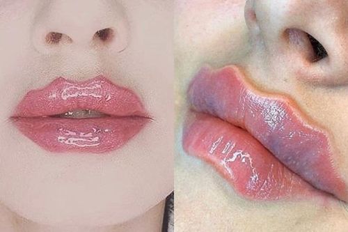 Bờ môi lượn sóng kỳ quái đang gây sốt