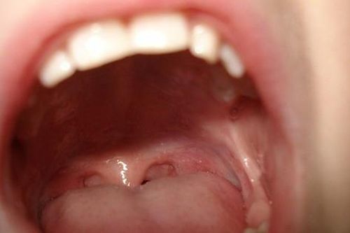 Bị sâu răng và răng ố vàng dù không ăn uống đồ ăn có axit, người đàn ông giật mình khi bác sĩ phát hiện mắc bệnh ung thư dạ dày