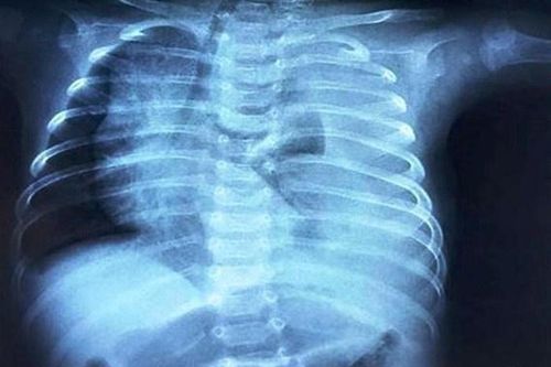 Em bé nguy kịch vì nửa lít dịch tràn vào màng phổi